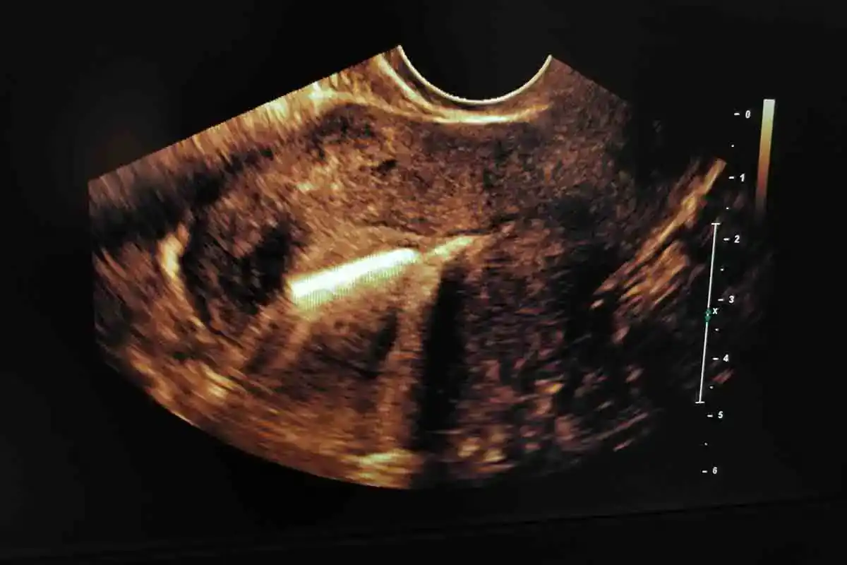 Pregnancy and IUD
