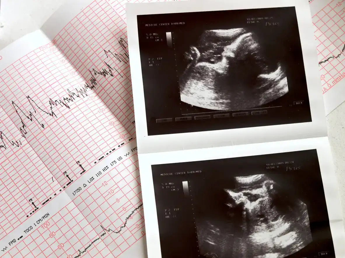 When Can You Hear A Baby’s Heartbeat?