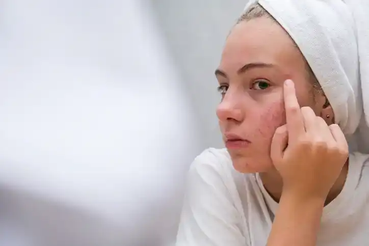 Skincare and Acne Treatments 